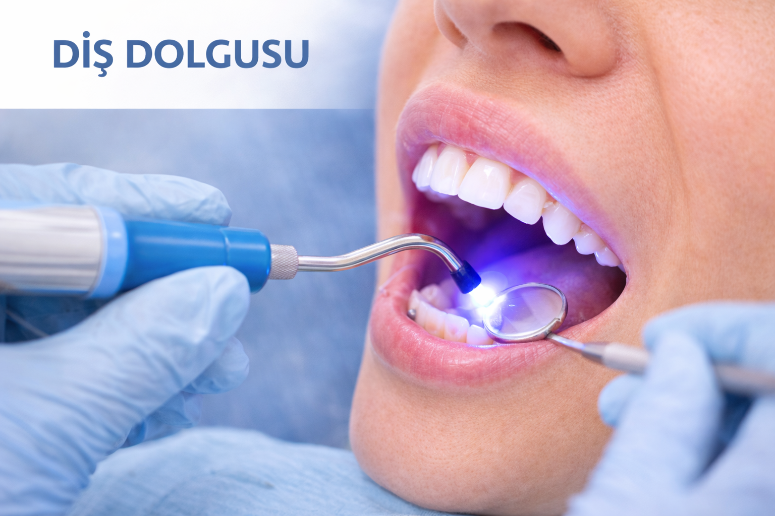 Diş Dolgusu