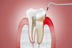 Periodontal Tedavi (Diş Eti Tedavisi)